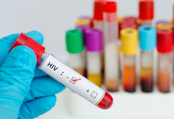 Khi nào cần xét nghiệm HIV và giá xét nghiệm bao nhiêu?